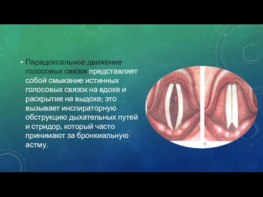 Парадоксальное движение голосовых связок представляет собой смыкание истинных голосовых связок на вдохе