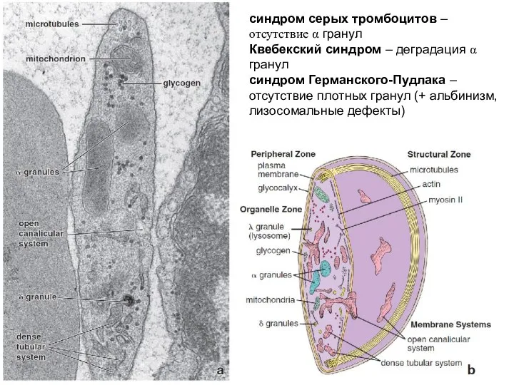 синдром серых тромбоцитов – отсутствие α гранул Квебекский синдром – деградация α