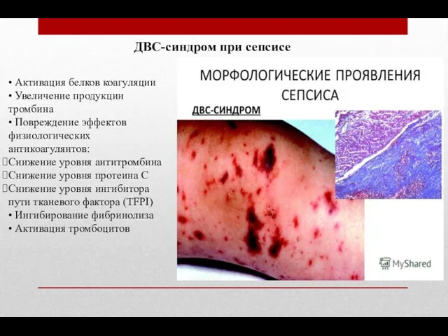 ДВС-синдром при сепсисе • Активация белков коагуляции • Увеличение продукции тромбина •