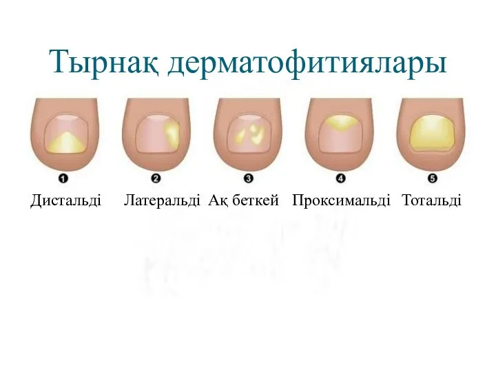 Тырнақ дерматофитиялары Дистальді Латеральді Ақ беткей Проксимальді Тотальді