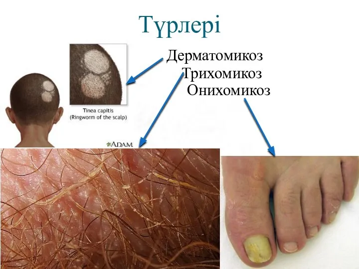 Түрлері Дерматомикоз Трихомикоз Онихомикоз