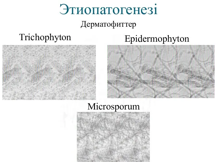 Этиопатогенезі Дерматофиттер Trichophyton Microsporum Epidermophyton