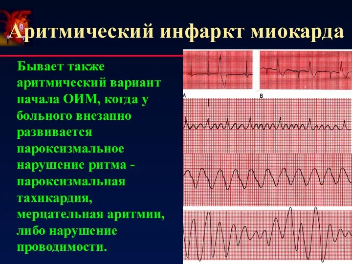 Аритмический инфаркт миокарда Бывает также аритмический вариант начала ОИМ, когда у больного