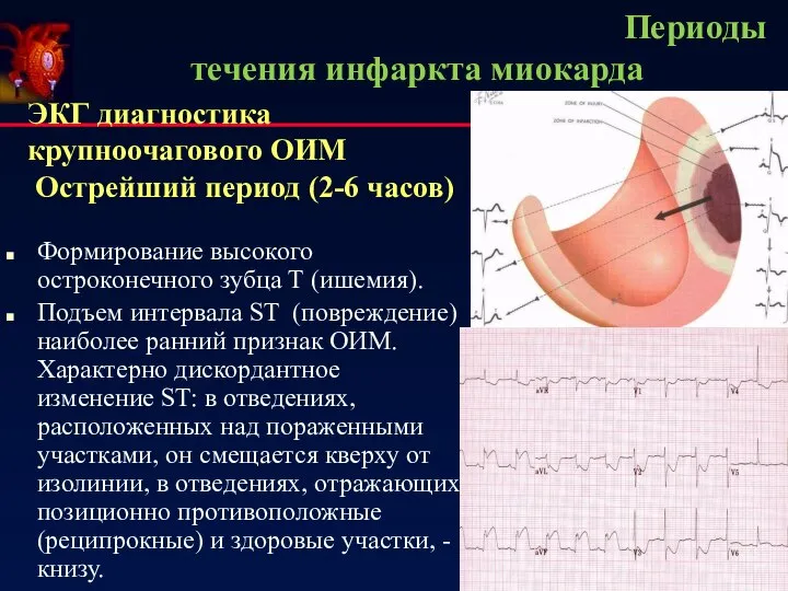 Периоды течения инфаркта миокарда ЭКГ диагностика крупноочагового ОИМ Острейший период (2-6 часов)