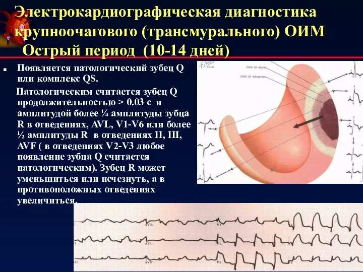 Электрокардиографическая диагностика крупноочагового (трансмурального) ОИМ Острый период (10-14 дней) Появляется патологический зубец