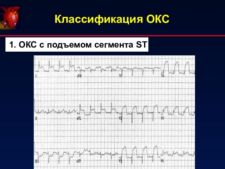 Классификация ОКС 1. ОКС с подъемом сегмента ST