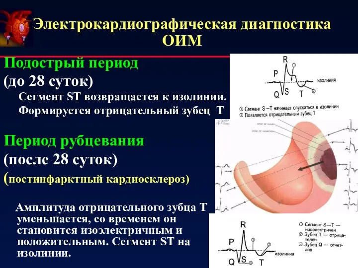 Электрокардиографическая диагностика ОИМ Подострый период (до 28 суток) Сегмент ST возвращается к