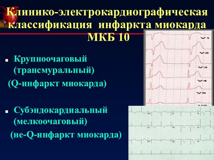 Клинико-электрокардиографическая классификация инфаркта миокарда МКБ 10 Крупноочаговый (трансмуральный) (Q-инфаркт миокарда) Субэндокардиальный (мелкоочаговый) (не-Q-инфаркт миокарда)