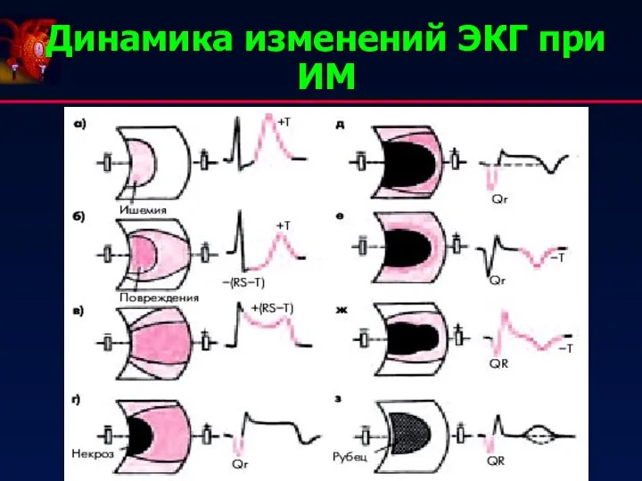 Динамика изменений ЭКГ при ИМ