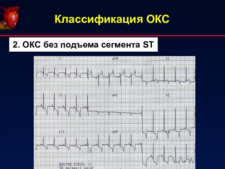 Классификация ОКС 2. ОКС без подъема сегмента ST