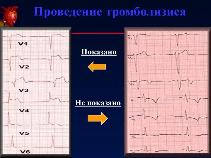 Проведение тромболизиса Показано Не показано