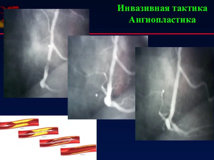 Инвазивная тактика Ангиопластика