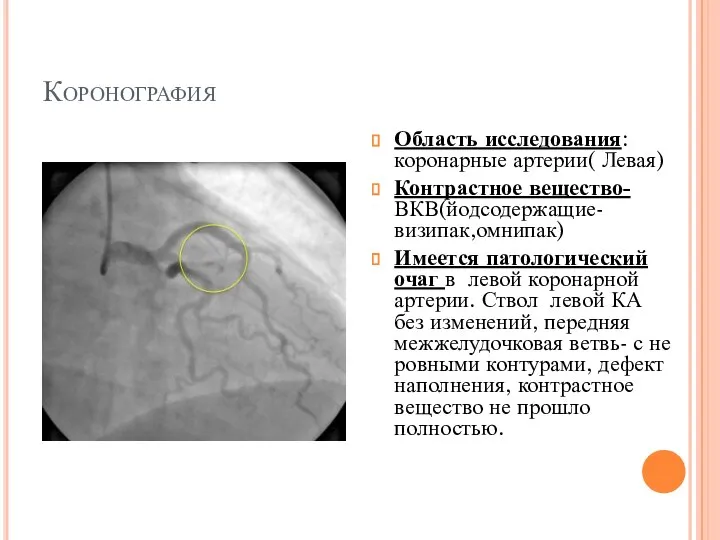 Коронография Область исследования: коронарные артерии( Левая) Контрастное вещество- ВКВ(йодсодержащие-визипак,омнипак) Имеется патологический очаг