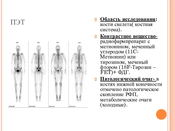 ПЭТ Область исследования: кости скелета( костная система). Контрастное вещество- радиофармпрепарат с метионином,
