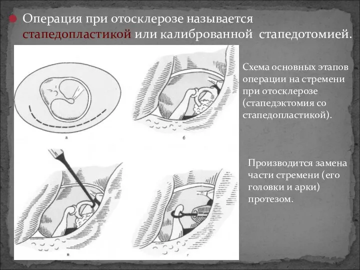 Операция при отосклерозе называется стапедопластикой или калиброванной стапедотомией. Схема основных этапов операции