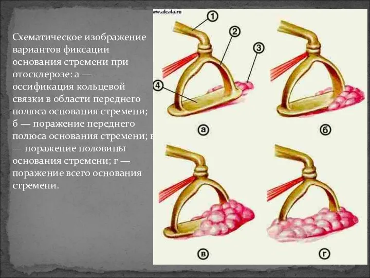 Схематическое изображение вариантов фиксации основания стремени при отосклерозе: а — оссификация кольцевой