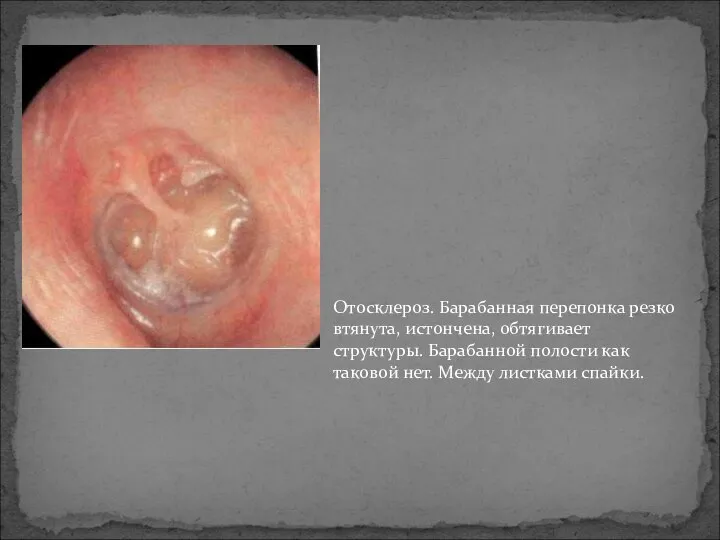 Отосклероз. Барабанная перепонка резко втянута, истончена, обтягивает структуры. Барабанной полости как таковой нет. Между листками спайки.