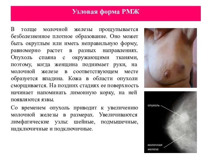 Узловая форма РМЖ В толще молочной железы прощупывается безболезненное плотное образование. Оно