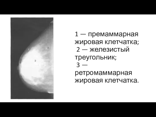 1 — премаммарная жировая клетчатка; 2 — железистый треуголь­ник; 3 —ретромаммарная жировая клетчатка.