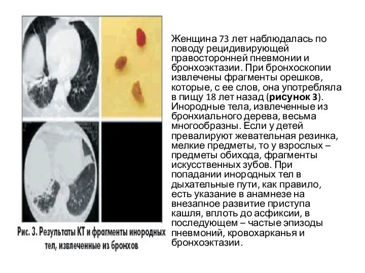 Женщина 73 лет наблюдалась по поводу рецидивирующей правосторонней пневмонии и бронхоэктазии. При