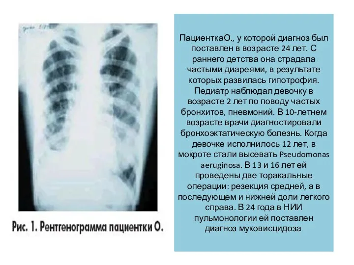 ПациенткаО., у которой диагноз был поставлен в возрасте 24 лет. С раннего