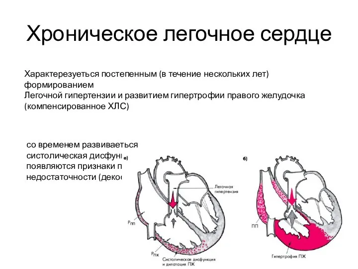 Хроническое легочное сердце Характерезуеться постепенным (в течение нескольких лет) формированием Легочной гипертензии