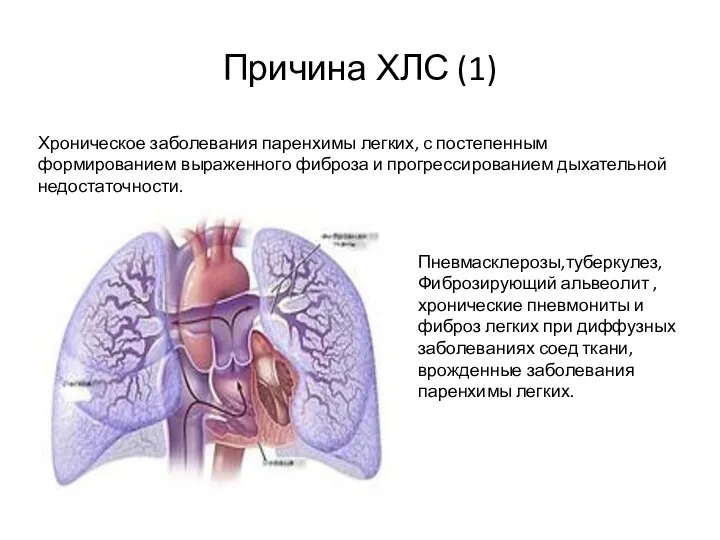 Причина ХЛС (1) Хроническое заболевания паренхимы легких, с постепенным формированием выраженного фиброза