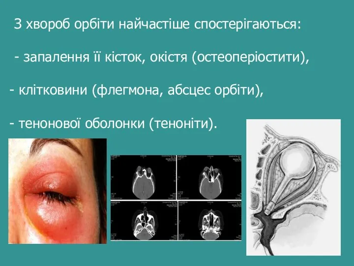 З хвороб орбіти найчастіше спостерігаються: - запалення її кісток, окістя (остеоперіостити), клітковини