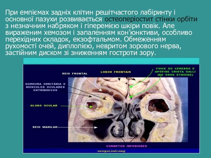 При емпіємах задніх клітин решітчастого лабіринту і основної пазухи розвивається остеоперіостит стінки