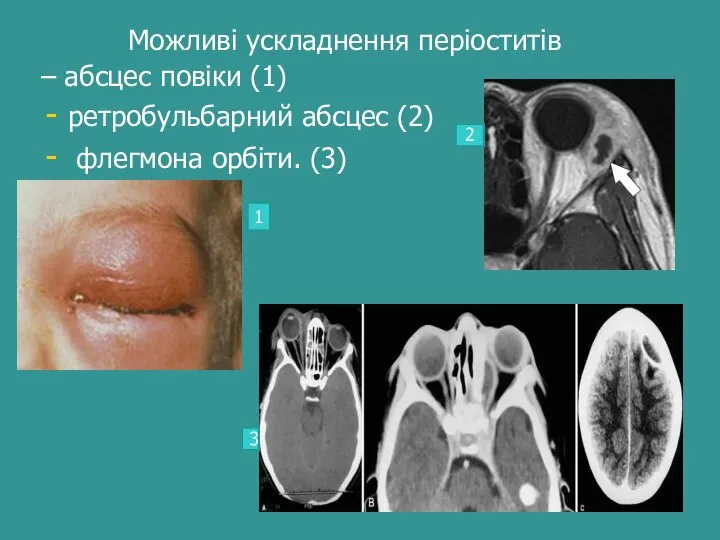 Можливі ускладнення періоститів – абсцес повіки (1) ретробульбарний абсцес (2) флегмона орбіти. (3) 2 3 1