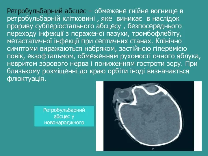 Ретробульбарний абсцес – обмежене гнійне вогнище в ретробульбарній клітковині , яке виникає