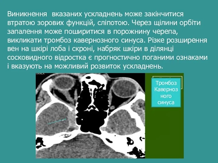 Виникнення вказаних ускладнень може закінчитися втратою зорових функцій, сліпотою. Через щілини орбіти