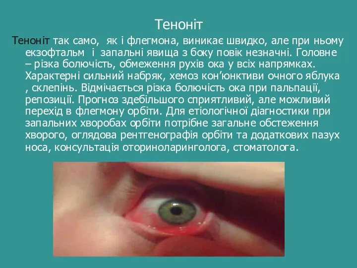 Теноніт Теноніт так само, як і флегмона, виникає швидко, але при ньому