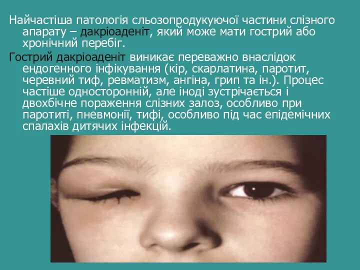 Найчастіша патологія сльозопродукуючої частини слізного апарату – дакріоаденіт, який може мати гострий