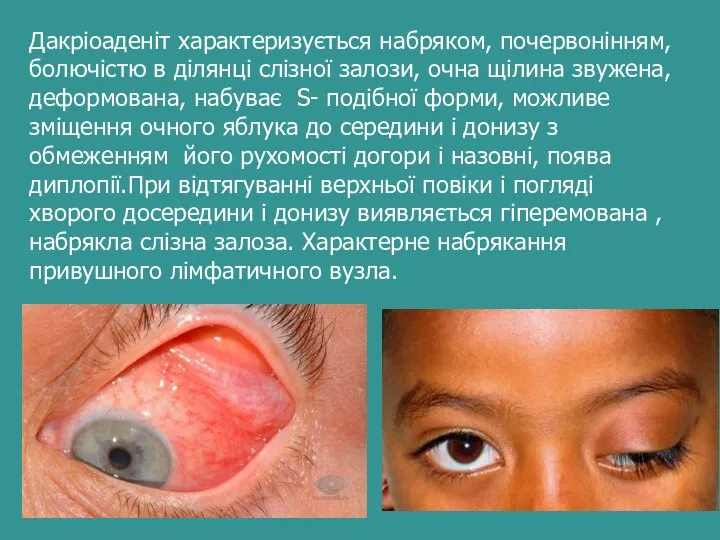 Дакріоаденіт характеризується набряком, почервонінням, болючістю в ділянці слізної залози, очна щілина звужена,