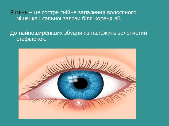 Ячмінь – це гостре гнійне запалення волосяного мішечка і сальної залози біля