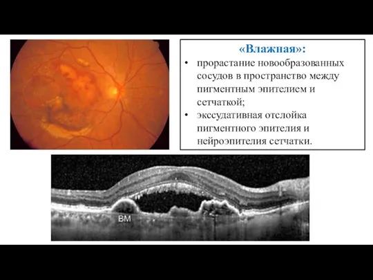 «Влажная»: прорастание новообразованных сосудов в пространство между пигментным эпителием и сетчаткой; экссудативная