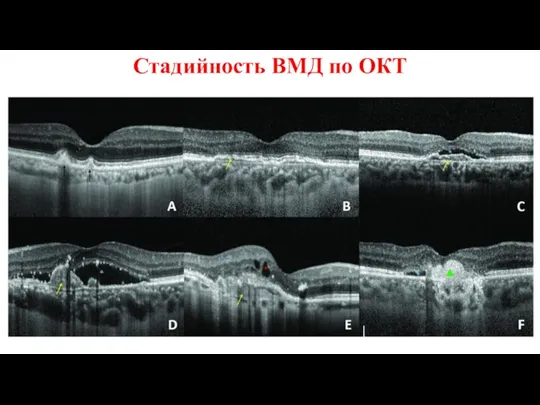 Стадийность ВМД по ОКТ