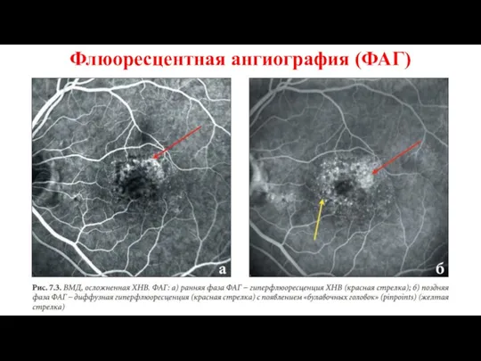 Флюоресцентная ангиография (ФАГ)