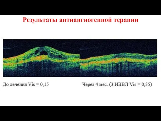 Результаты антиангиогенной терапии