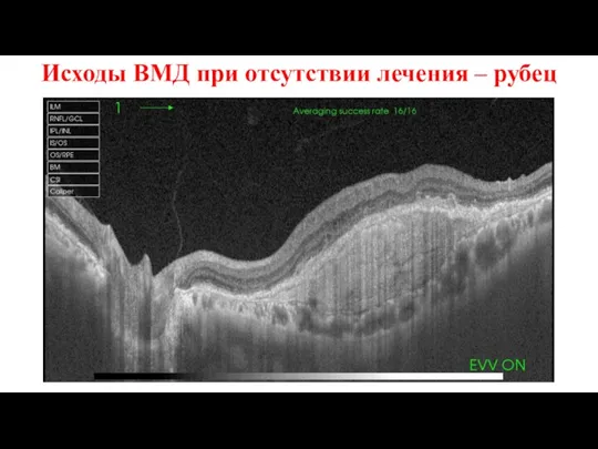 Исходы ВМД при отсутствии лечения – рубец