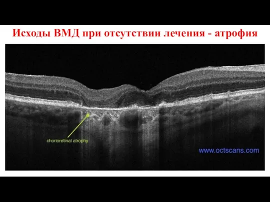 Исходы ВМД при отсутствии лечения - атрофия