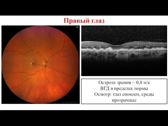 Правый глаз Острота зрения = 0,8 н/к ВГД в пределах нормы Осмотр: глаз спокоен, среды прозрачные