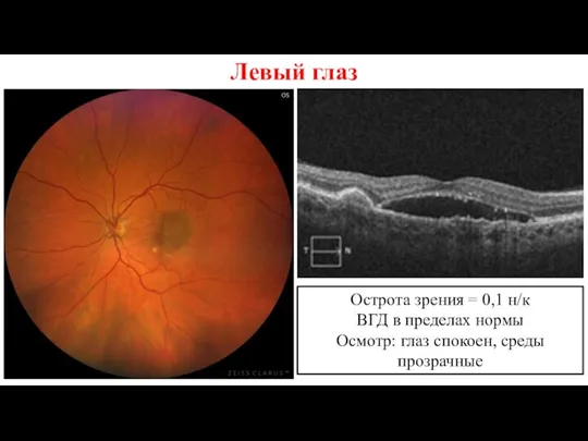 Левый глаз Острота зрения = 0,1 н/к ВГД в пределах нормы Осмотр: глаз спокоен, среды прозрачные