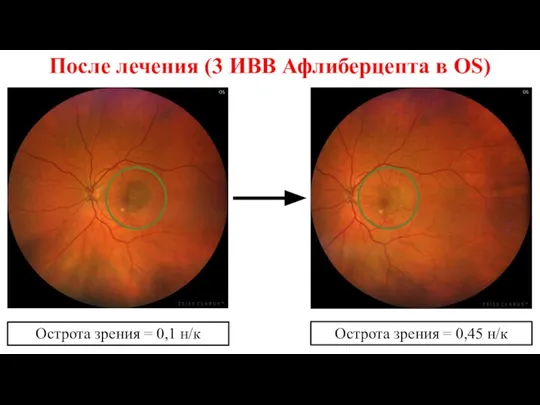 После лечения (3 ИВВ Афлиберцепта в OS) Острота зрения = 0,1 н/к