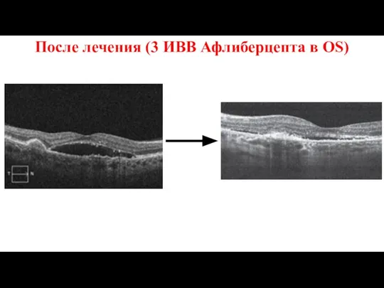 После лечения (3 ИВВ Афлиберцепта в OS)