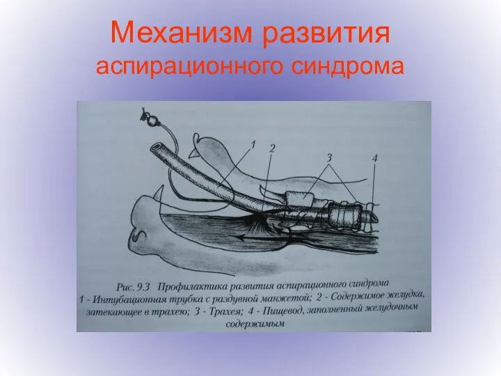 Механизм развития аспирационного синдрома