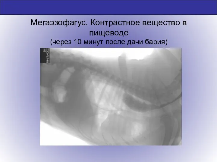 Мегаэзофагус. Контрастное вещество в пищеводе (через 10 минут после дачи бария)