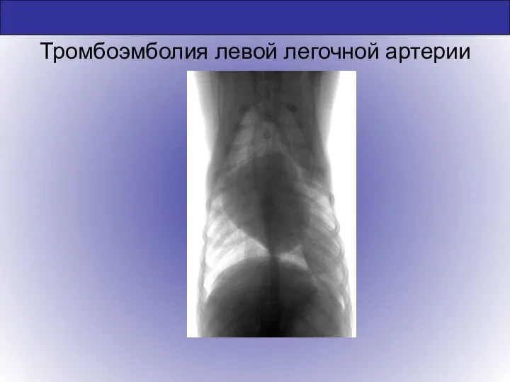 Тромбоэмболия левой легочной артерии