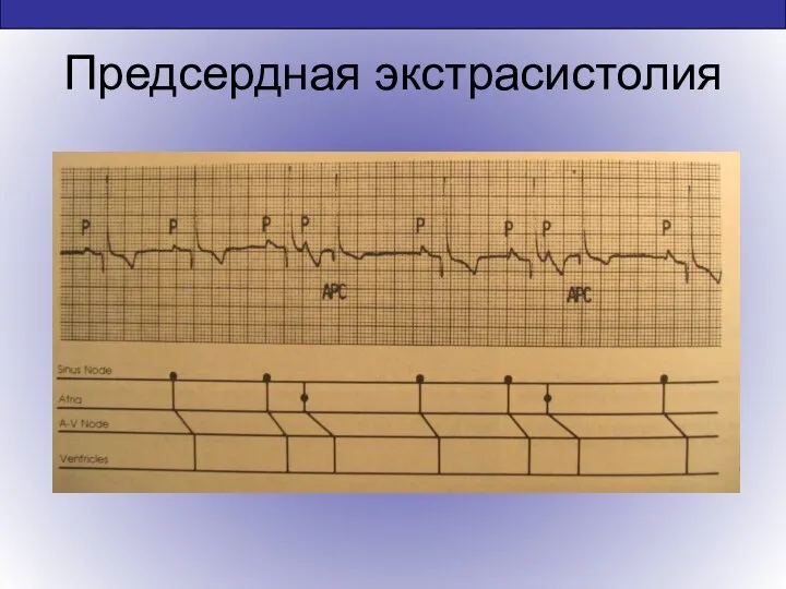 Предсердная экстрасистолия